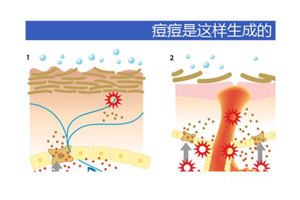 長痘就是排毒嗎？后青春期爆痘多數是過敏